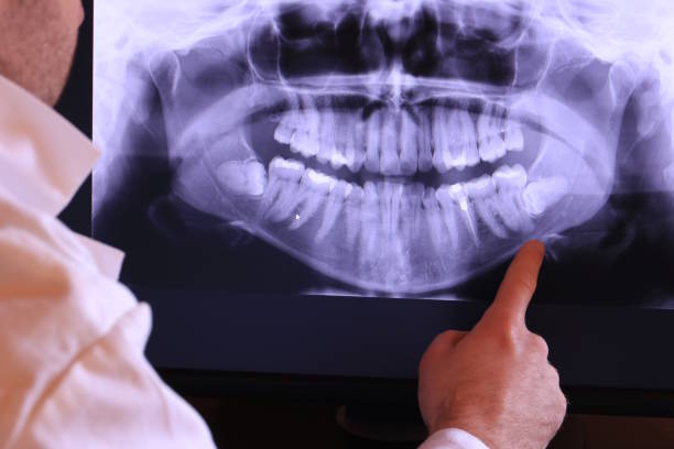 Best Emergency Root Canal Treatment in Johnsburg, IL