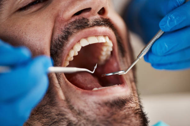 Best Emergency Wisdom Teeth Removal in Johnsburg, IL