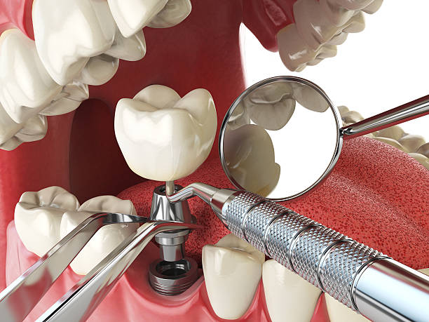 Best Emergency Denture Repair in Johnsburg, IL